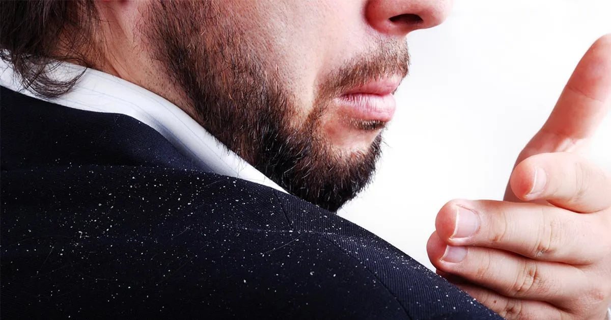 How to Get Rid of Dandruff & Flakes - Hair Care Tips For Men