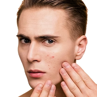 Oily and Acne Prone Skin