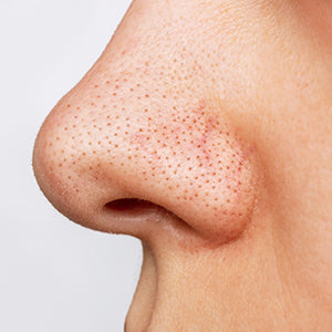 Blackheads Treatment for Men