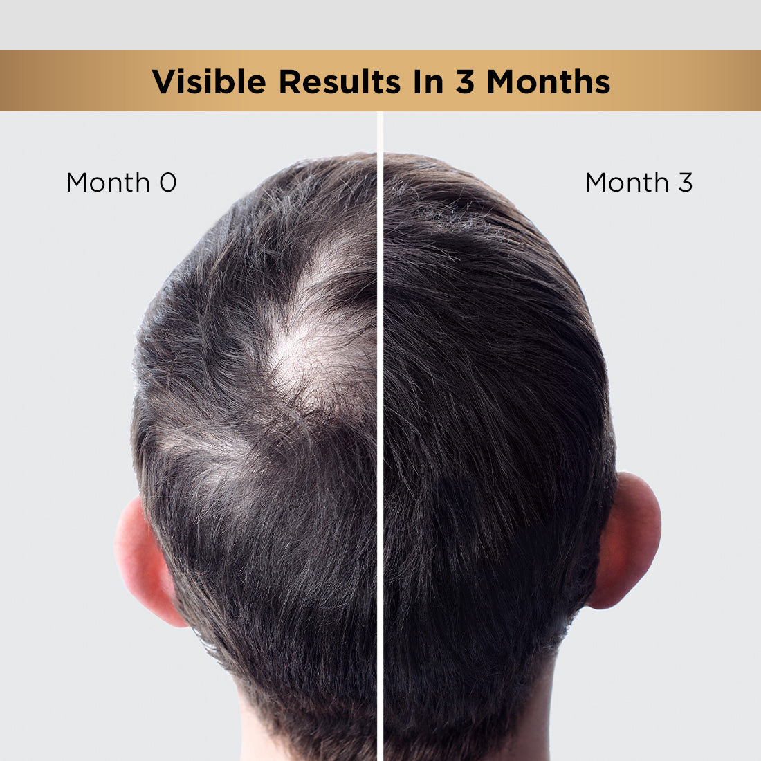 Hair Regrowth Kit for Men: Ultimate Solution to Thicker Hair