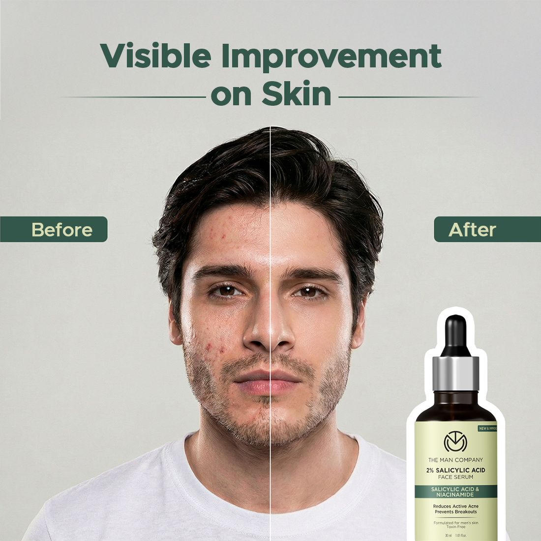 2% Salicylic Acid | Anti-Acne Serum