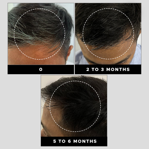 grey-hair-remedy-kit